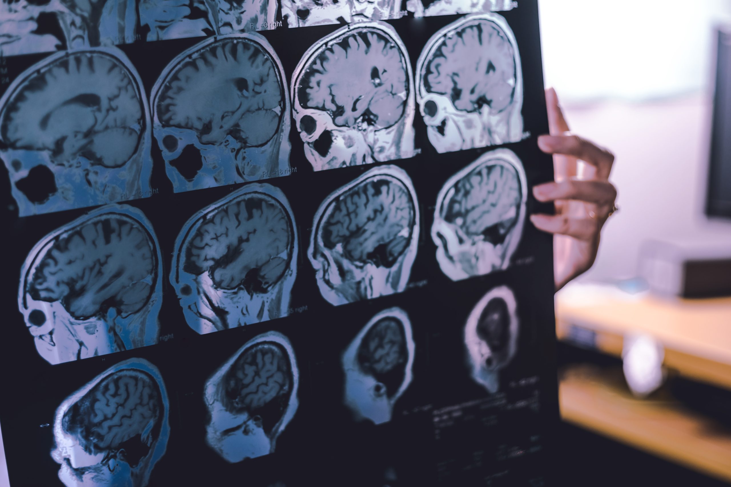 dementia detection