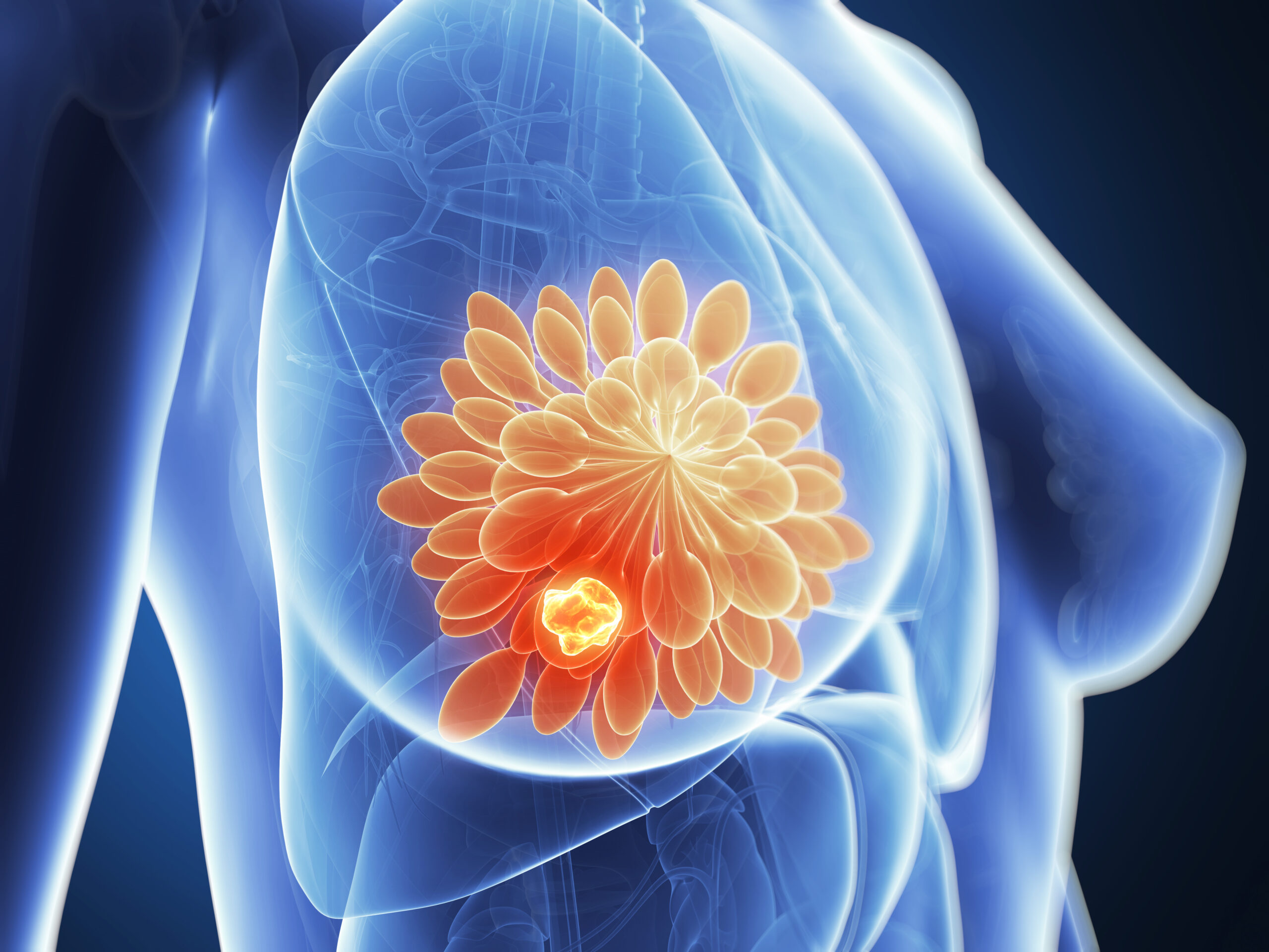 Why Catching Breast Cancer Early Saves Lives